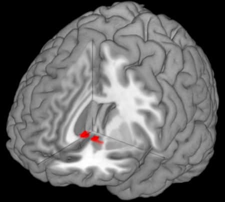 Nucleo Accumbens